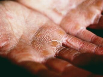 pure patchouli oil, acne skin, women's patchouli perfume, skin condition