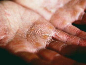 pure patchouli oil, acne skin, women's patchouli perfume, skin condition